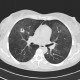 Wegener's granulomatosis, development in time, year one: CT - Computed tomography